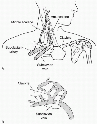 Angioplasty and Stenting for Chronic Venous Disease | Radiology Key