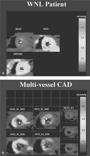 PET Measurement of Myocardial Blood Flow | Radiology Key