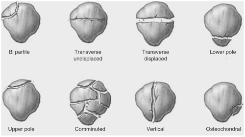 Wimberg Patella Morphology Types