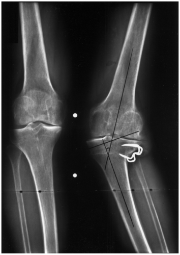 The Knee | Radiology Key