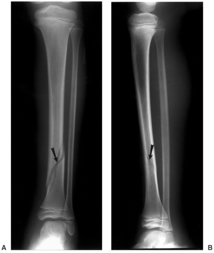 open tib fib fracture x ray