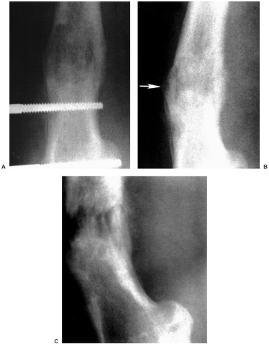 Tibial and Fibular Shafts | Radiology Key