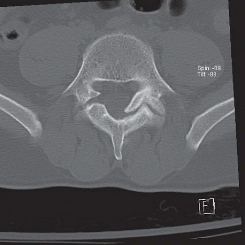 Neuroradiology: Spine Imaging | Radiology Key