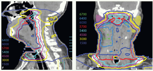 Larynx | Radiology Key