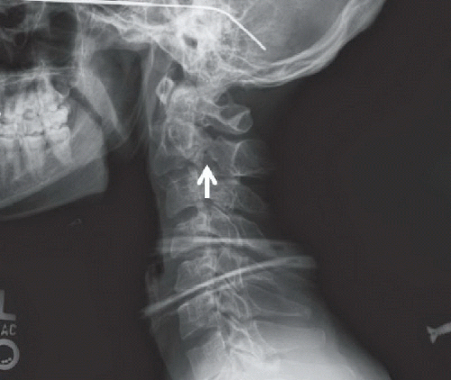 Hangman Fracture Radiology Key