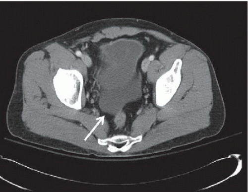 Bladder Rupture Radiology Key 