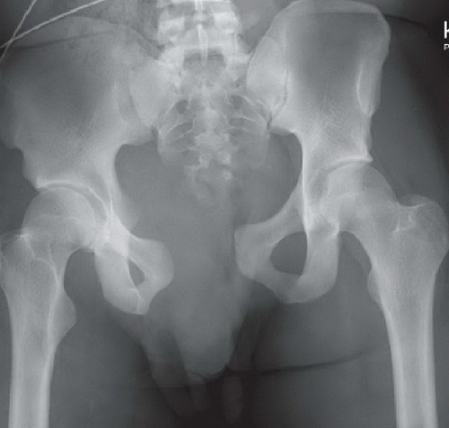 What are open book pelvic fractures?