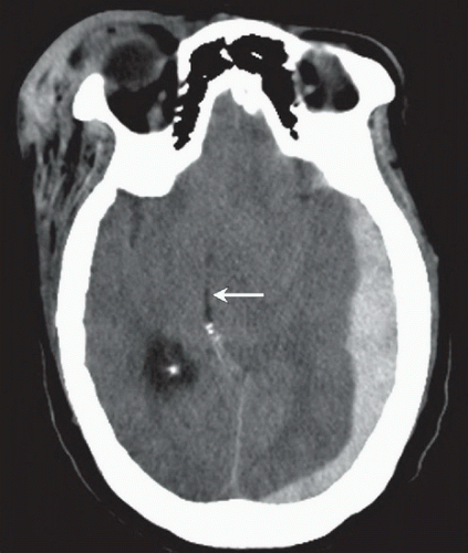 Subdural hematoma radiology