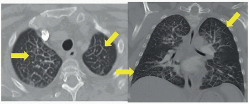 Pulmonary Edema (Interstitial) | Radiology Key