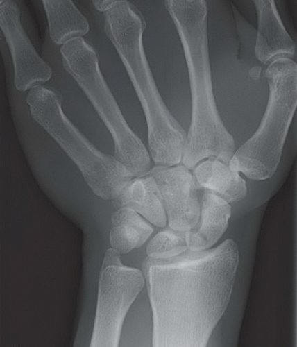 Scaphoid Bone Anatomy