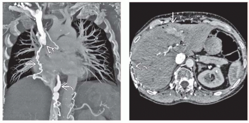 Superior Vena Cava Obstruction Radiology Key 7227