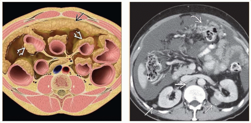 peritoneal-metastases-radiology-key