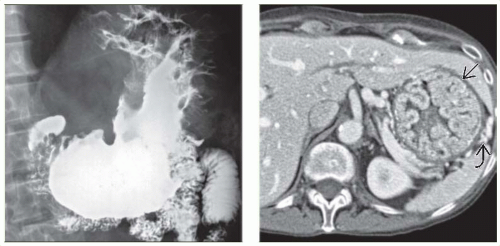 Menetrier Disease Radiology Key