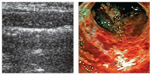 Ischemic Colitis Radiology Key