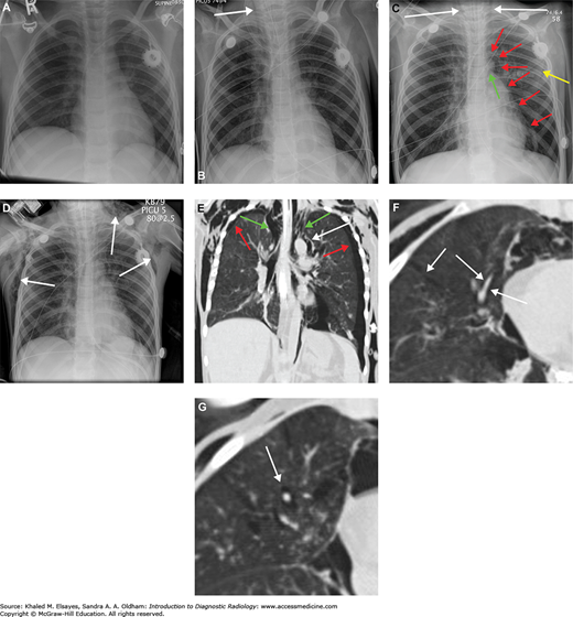 pulmonary barotrauma icd 10