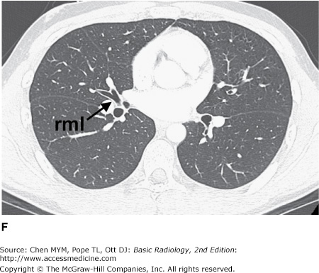 Chapter 4. Radiology of the Chest | Radiology Key