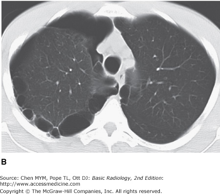 Chapter 4 Radiology Of The Chest Radiology Key