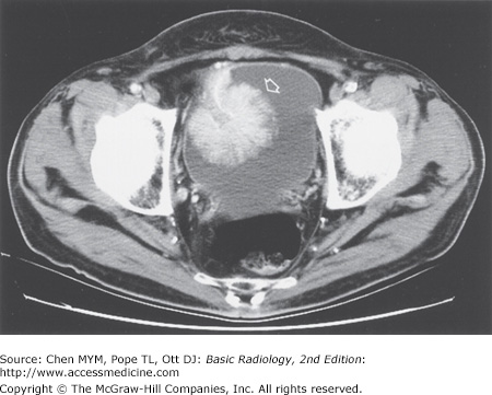 Chapter 9. Radiology Of The Urinary Tract | Radiology Key