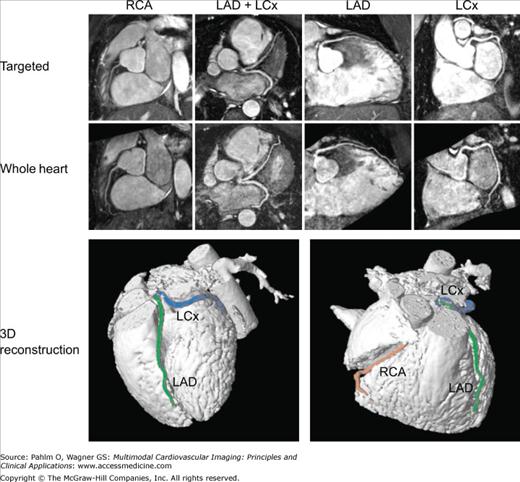 Cardiac Magnetic Resonance Imaging In Ischemic Heart Disease ...