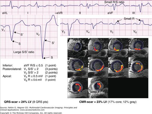 electrocardiography-of-ischemic-heart-disease-radiology-key