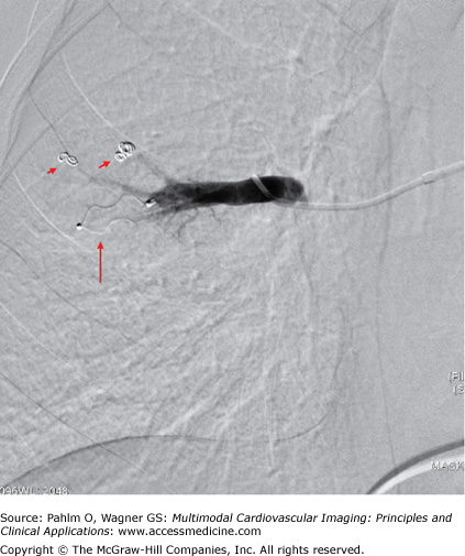 Pulmonary Vascular Disease | Radiology Key