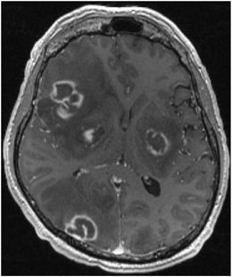 Structural MRI in Idiopathic Parkinson Disease and Parkinsonism