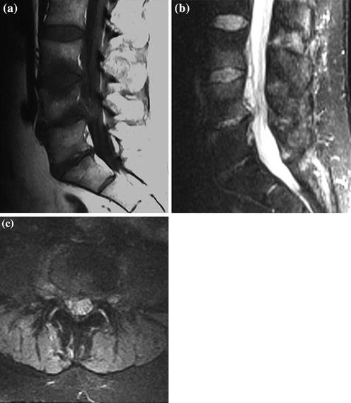 Herniated Lumbar Disk Intradiskal Percutaneous Procedure | Radiology Key