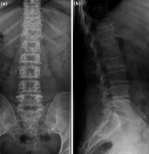 Recurrent Herniated Lumbar Disk | Radiology Key