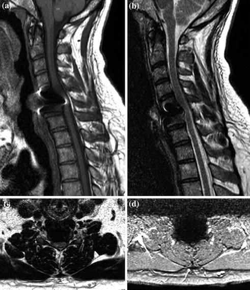 Herniated Cervical Disk Anterior Diskectomy | Radiology Key