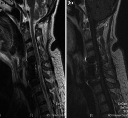 Cervical Spondylodiscitis Corpectomy | Radiology Key