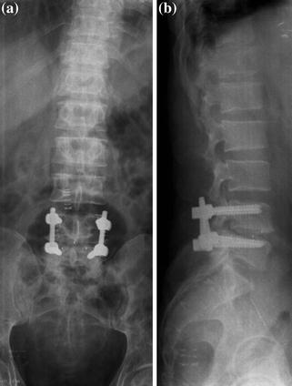 Lumbar Stenosis and Degenerative Instability Posterior Rigid ...