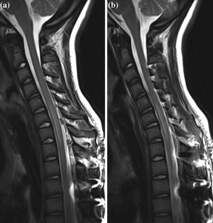 Scoliosis Stabilization | Radiology Key