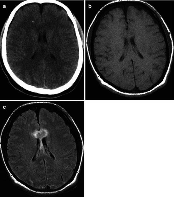 Neuroimaging Classification of Traumatic Brain Injury | Radiology Key