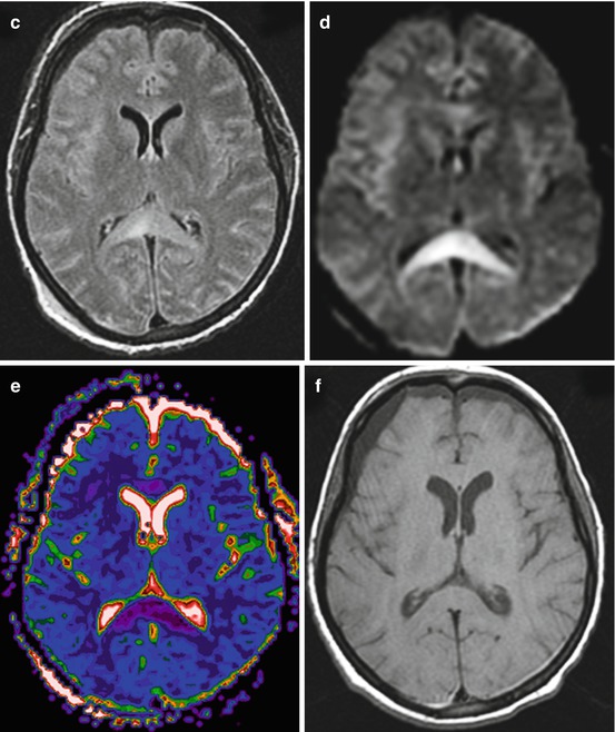 Neuroimaging Classification Of Traumatic Brain Injury | Radiology Key