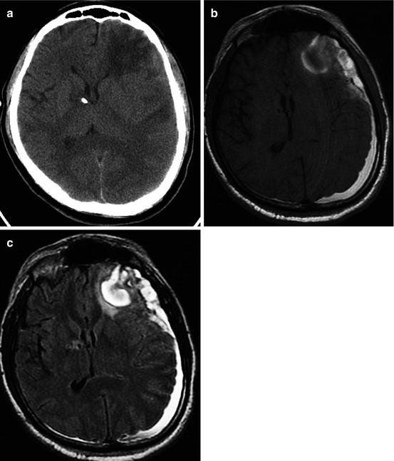 Neuroimaging Classification of Traumatic Brain Injury | Radiology Key