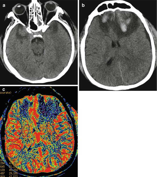 Mapping of Cerebral Blood Flow in Focal and Diffuse Brain Injury ...