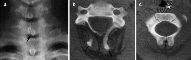 Spine Development Radiology Developmental Anatomy | Radiology Key