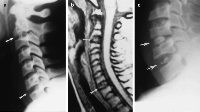 Miscellaneous Cervical Spine Problems | Radiology Key