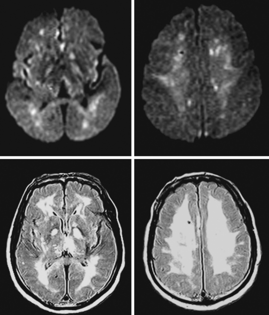 Hypoxic-Ischemic Brain Damage | Radiology Key