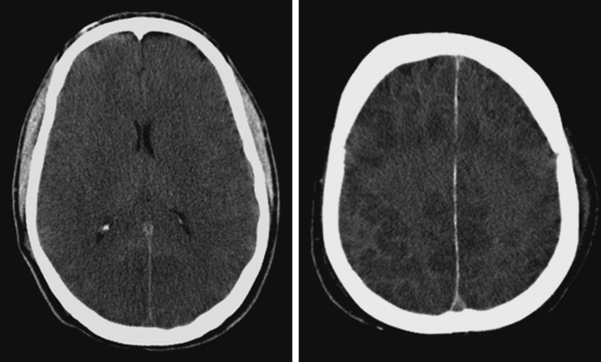 Hypoxic Ischemic Brain Damage Radiology Key