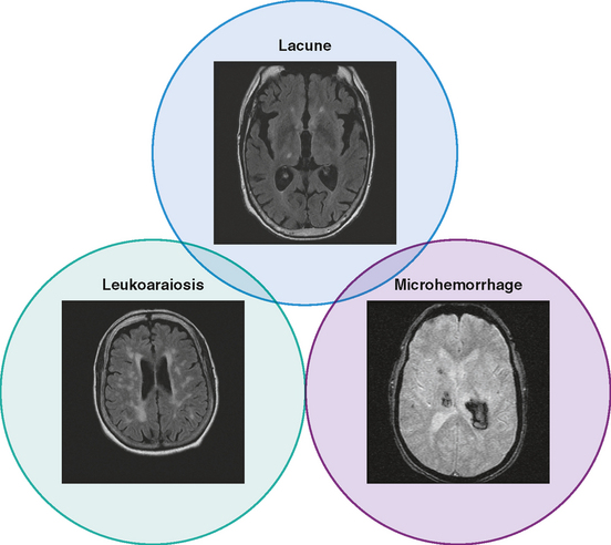 Small Vessel Ischemic Disease Cerebral Csvd Vascular Svn Bmj Diseases 