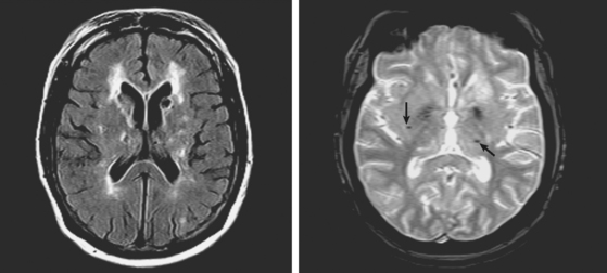 small-vessel-disease-radiology-key