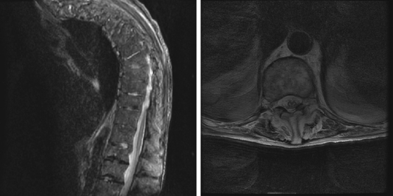 Spinal Cord Infarction | Radiology Key