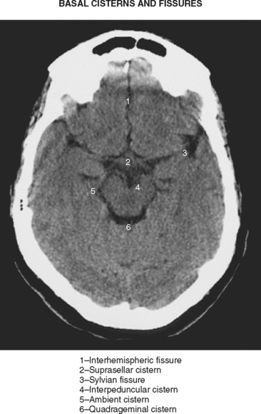 subarachnoid hemorrhage mri