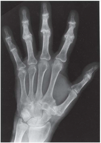 Hand and Wrist | Radiology Key