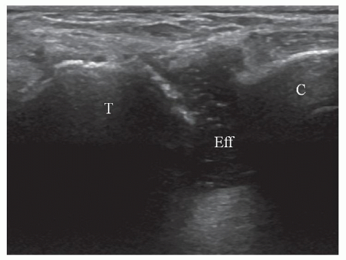 icd-10-code-for-soft-tissue-mass-right-foot