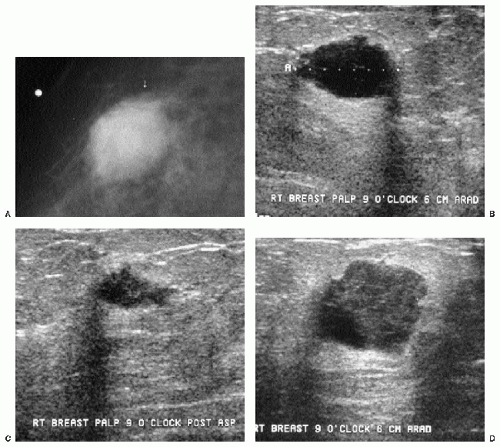 A 36-year-old patient with grade NOS II invasive breast cancer. A. The