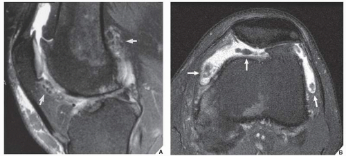 Radiologic Evaluation Of The Arthritides | Radiology Key