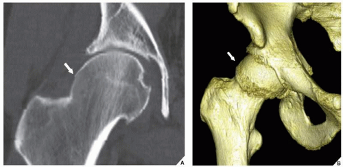 Degenerative Joint Disease | Radiology Key