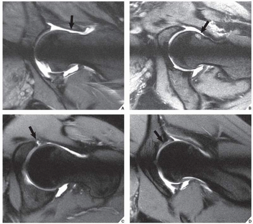 Degenerative Joint Disease | Radiology Key